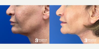 55-64 year old woman treated with AccuTite - This patient is a 56-year-old female who had concerns with her lower face and neck. Dr. Cho performed MyEllevate and accutite. After photos are 3 months post procedure.