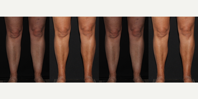 45-54 year old woman treated with Calf Reduction - Before and 4 months after Liposuction to Ankles, Calves and Medial Knees.