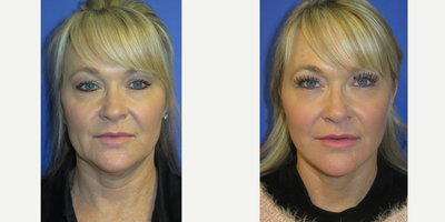 49 year old woman treated with Lower Face Lift - 49 year old female with a loose neck and skin. She was treated with our FACEology Lift(Lower Neck and Facelift) under local anesthesia and oral sedation.