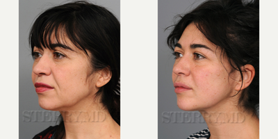 45-54 year old woman treated with Mini Lift - This is a 48 year old woman who wanted something to freshen her up a bit. She had found that fillers and botox weren't going to give her what she wanted and chose to have a form of mini facelift trademarked by Dr. Sterry and the Naturalift&trade;. This is a short scar facelift that is performed through a small incision.