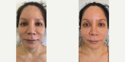 Woman treated with Vampire Facelift - Woman treated with Vampire Facelift