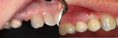 45-54 year old woman treated with Mini Dental Implants - Upper right first premolar tooth was fractured. The tooth was safely removed and restored with Implant in a day. The after picture is taken two weeks after the procedure during the follow-up visit.