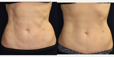 35-44 year old woman treated with Skin Tightening - Mother of 2 with BMI 19 wanted abdominal skin tightening. Treated with Cool Helium Plasma Renuvion technology and 150 cc VASER liposuction. Pic 1 is 1 month results and Pic 2 shows continued tightening and contouring at 2 months. See video section as well.