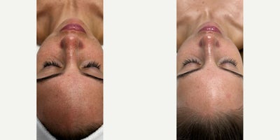 25-34 year old woman treated with Facial, Skin Rejuvenation - IS Clinical Fire and Ice Facial with Alyssa G