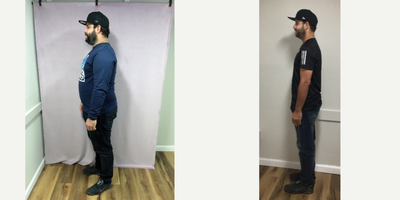 25-34 year old man treated with Endoscopic Sleeve Gastroplasty - The patient had his Endoscopic Sleeve Gastroplasty procedure done by Dr. Batash. He lost 83 Lbs over five months.