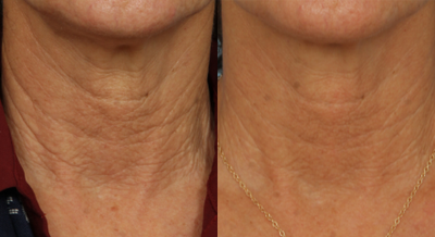 55-64 year old woman treated with Vivace - Patient received 2 Vivace treatments to her neck. Photos were taken 9 months apart.