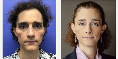 Patient treated with Facial Feminization Surgery, Transgender Facial Feminization Surgery, Rhinoplasty, Septoplasty, Voluma, Che - 35 to 44 year-old female patient is 5.5 months post-op from Facial Feminization surgery. Her procedures included: Forehead Lift and Orbital Bony Contouring, Septorhinoplasty (closed) with Cartilage Grafts and Weirs, Chin Reduction and Contour, Soft Tissue to Nasolabial Folds, Intranasal Lip Lift with Fascia to Lips, Thyroid Cartilage Shave and Voice Feminization, 2 cc Voluma to Cheeks, and 400 Micrografts to Recessions.