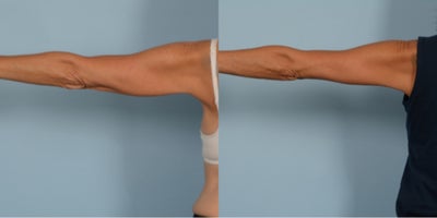 55-64 year old woman treated with Arm Lift - Brachioplasty