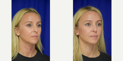 2559 - 25-34 year old woman treated with Rhinoplasty