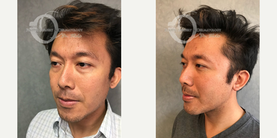 35-44 year old man treated with Facial Fat Transfer - fat transfer to cheek and lower eyelid surgery