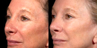 Woman treated with Pearl Laser - Pearl Laser