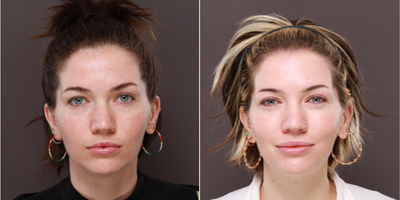 25-34 year old woman treated with Moxi - This patient had 2 Moxi Treatments to reduce pigment and improve overall tone and texture. Moxi is a low downtime laser surfacing treatment for younger patients or early signs of aging.