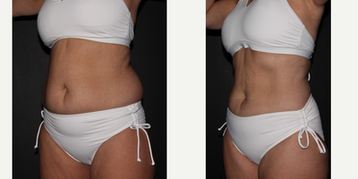 45-54 year old woman treated with UltraShape Power and Velashape - Ultrashape and Velashape