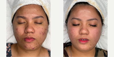 25-34 year old woman treated with HydraFacial - HydraFacial performed at 8 West Clinic, Vancouver, BC