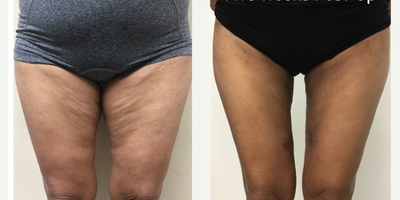 55-64 year old woman treated with Renuvion - Renuvion Skin Tightening Thighs
