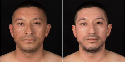 Cosmelan - Male-30s-one month post op