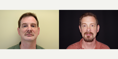 45-54 year old man treated with ArteFill - 51 year old male received Bellafill to the right cheek; photos depict the patient's results 4 months post-treatment.