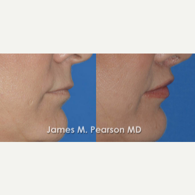 45-54 year old woman treated with Lip Lift - Lip Lift / Sub-nasal / Bullhorn
