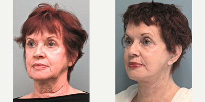 65-74 year old woman treated with Deep FX - The doctor performed his exclusive LiteLift lower face, Deep Plane Facelift & Neck Lift to improve the signs of facial aging. Notice the dramatic improvement along her jawline and neck. She has elegant facial contours after surgery. After photos were taken 4 months post-op.