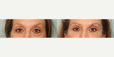 55-64 year old woman treated with Eyelid Surgery - Performed by Dr.Sozer
