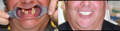 All-on-4 Dental Implants  - The All-on-4 is the modern solution for all missing teeth. This treatment concept replaces your missing teeth with a Full Dental Bridge, No Palate, No Excess Material, Not Removable, and supported by only Four Specialty Dental Implants, with two of the Implants placed at precise angles. With less implants needed, overall treatment time is reduced. The unique All-on-4 solution also ensures greater stability in the bone, reducing the need for bone graft surgery to increase bone volume. Your teeth will look, feel and are brushed much like natural teeth, and you can lead a normal life immediately after a 1 Day surgery. Studies indicate that Patients receive 90-95% chewing ability. Your quality of life is improved and you can start enjoying your favorite foods again.