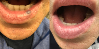 45-54 year old man treated with Excel V - After 1 treatment