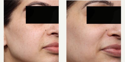 38 year old woman treated with PicoWay - This 38 year old female wanted to address concerns about hyperpigmentation and uneven skin tone. She underwent a Pico laser treatment to target pigmentation at multiple skin depths, improving clarity and overall radiance. The procedure helped break down excess pigment while stimulating collagen for smoother, brighter skin. At her follow-up, her complexion appeared more even, refreshed, and rejuvenated.
