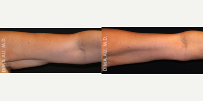 55-64 year old woman treated with Venus Freeze - At WellMedica we provide Venus Freeze treatments for the arms. Venus Freeze is suitable for various face and body applications including circumference reduction, cellulite improvement, skin tightening and wrinkle reduction. Treatments are safe, quick and effective for all skin types.