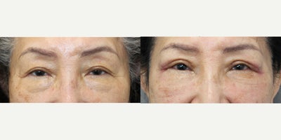 65-74 year old woman treated with Eyelid Surgery, Ptosis Surgery - This patient came in after a previous eyelid surgery that left her with droopy upper lids and a tired appearance. We performed REVISION UPPER EYELID SURGERY (BLEPHAROPLASTY + PTOSIS REPAIR) to lift and open her eyes for a brighter, refreshed look and LOWER BLEPHAROPLASTY (TRANSCONJUNCTIVAL + FAT REPOSITIONING) to treat her lower eyelid bags.