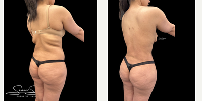 26 year old woman treated with Liposuction, Lymphatic Massage, Renuvion, Skin Tightening, Vaser Liposuction - 26 year old amazing patient that underwent VASER assisted liposculpting and Renuvion J plasma skin tightening of the abdomen, flanks, upper/middle/lower back and a BBL procedure (fat transfer to the buttocks and lateral hips). Results shown are 3 months post-op.