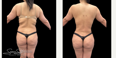 26 year old woman treated with Liposuction, Lymphatic Massage, Renuvion, Skin Tightening, Vaser Liposuction - 26 year old amazing patient that underwent VASER assisted liposculpting and Renuvion J plasma skin tightening of the abdomen, flanks, upper/middle/lower back and a BBL procedure (fat transfer to the buttocks and lateral hips). Results shown are 3 months post-op.