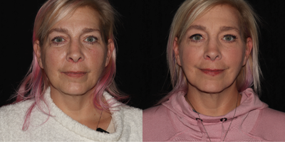 45-54 year old woman treated with Sofwave, Daxxify - Our lovely 52 year old client had Daxxify botox and a full face and neck Sofwave procedure. Her after image is 1 month after the Sofwave. She is enjoying an impressive amount of smoothing and tightening, and her results will continue to improve for 5 more months.