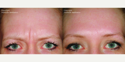 25-34 year old woman treated with Dysport - Dr. Rivkin injected Dysport, a dermal filler, to improve the look of the moderate to severe frown lines between her eyebrows (glabellar lines).