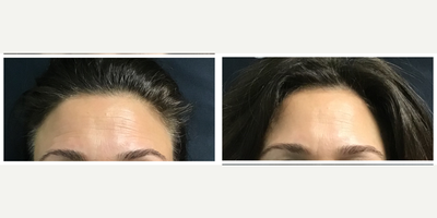 45-54 year old woman treated with Pelleve - 2 pelleve treatments