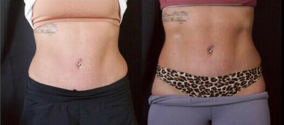 Woman treated with Cryoskin - Woman treated with Cryoskin