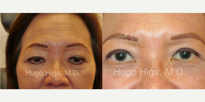 Eyelid Surgery - Eyelid Surgery