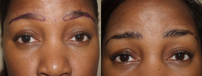 Eyebrow Transplantation - 	Before and after one hair transplantation procedure of 500 grafts.