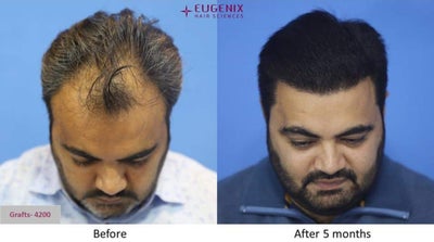 The Hair Transplant Thread - Page 7 - Team-BHP