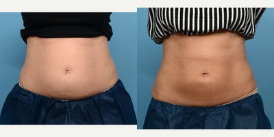 25-34 year old woman treated with Cryolipolysis - 1 session of CoolSculpting for the abdomen.