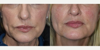 Los Angeles Sculptra injections for the cheeks, before and after photos - Patient is fifty something and felt like her face was thinning and falling.  For this type of patient, Sculptra is an awesome option to get more youthful volume back in the cheeks.  And it is so natural looking!