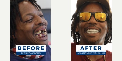 45-54 year old man treated with All-on-4 Dental Implants - You can get permanent, lasting teeth in 24 hours at Nuvia. Avoid waiting up to 10+ months for final teeth like traditional methods require.