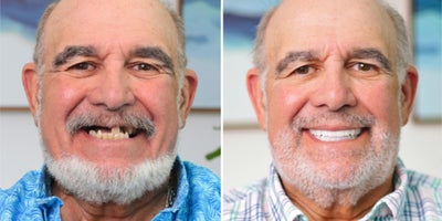 55-64 year old man treated with All-on-4 Dental Implants - You can get permanent, lasting teeth in 24 hours at Nuvia. Avoid waiting up to 10+ months for final teeth like traditional methods require.