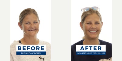 45-54 year old woman treated with All-on-4 Dental Implants - You can get permanent, lasting teeth in 24 hours at Nuvia. Avoid waiting up to 10+ months for final teeth like traditional methods require.