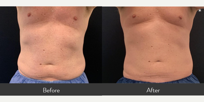 55-64 year old man treated with CoolSculpting Elite - Our 58 yr old male had 1 CoolSculpting Elite treatment to his abdomen and waist with 8 applicators. He is shown before and 8 weeks after his treatment.