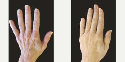 Woman treated with Hand Rejuvenation - Woman treated with Hand Rejuvenation, Dermal Fillers