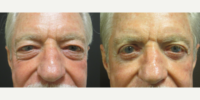 65-74 year old man treated with Eyelid Surgery - This patient had his upper and lower eyelids rejuvenated (Blepharoplasty)