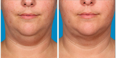 25-34 year old woman treated with Kybella for corruption of sub mental fullness /double chin - 25-34 year old woman treated with Kybella for corruption of sub mental fullness /double chin