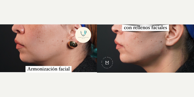 35-44 year old woman treated with Dermal Fillers, Teosyal - Facial balancing and Harmonization with jawline jowl reduction, Only facial dermal fillers used. Immediate results
