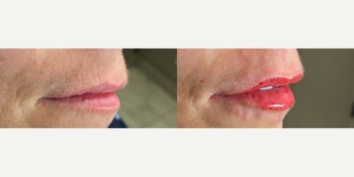 Woman treated with Lip Fillers - Woman treated with Lip Fillers