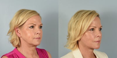 55-64 year old woman treated with Facelift, Neck Lift, Eyelid Surgery - 64 year old female who underwent Facelift, Neck Lift, upper and lower blepharoplasty, and temple lift 3 months ago.